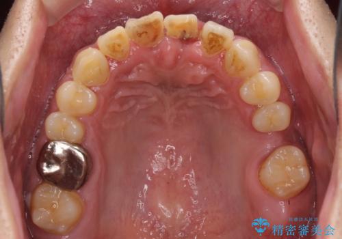 事故で抜歯となった前歯 ブリッジやインプラントによる補綴治療の治療前
