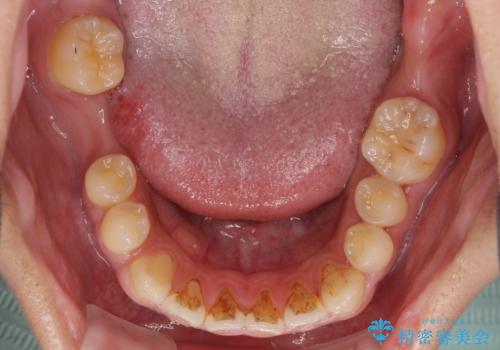 事故で抜歯となった前歯　ブリッジやインプラントによる補綴治療の治療前