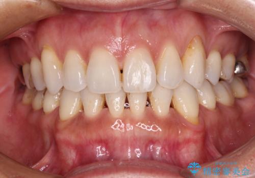 抜歯矯正の後戻りをインビザライン・ライトで解消の治療中