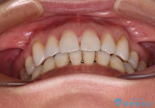 抜歯矯正の後戻りをインビザライン・ライトで解消の治療中