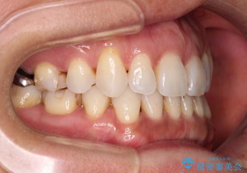 抜歯矯正の後戻りをインビザライン・ライトで解消の治療中