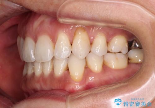抜歯矯正の後戻りをインビザライン・ライトで解消の治療中