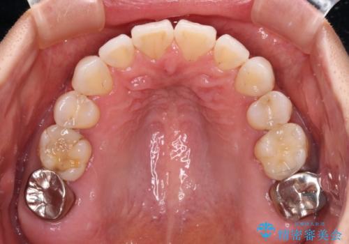 抜歯矯正の後戻りをインビザライン・ライトで解消の治療中