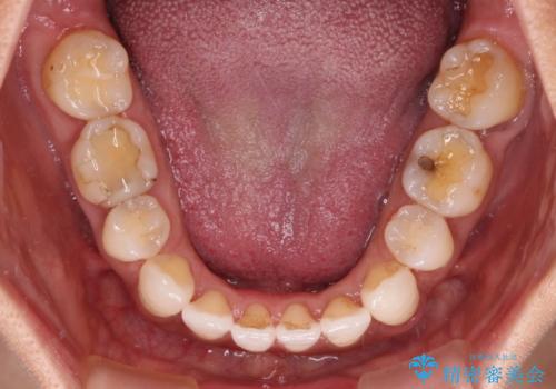 抜歯矯正の後戻りをインビザライン・ライトで解消の治療中