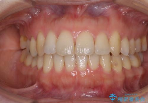 後戻りの再矯正治療と欠損部の補綴治療の治療中