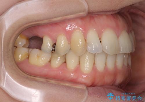 後戻りの再矯正治療と欠損部の補綴治療の治療中