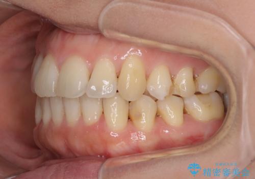 後戻りの再矯正治療と欠損部の補綴治療の治療中