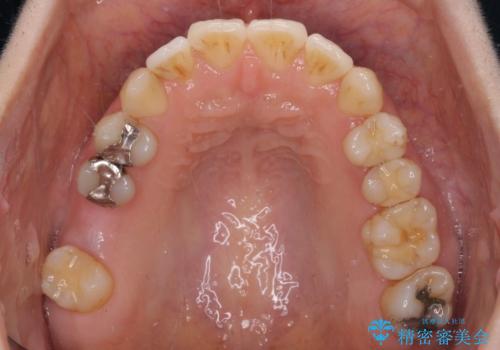 後戻りの再矯正治療と欠損部の補綴治療の治療中