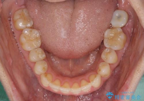後戻りの再矯正治療と欠損部の補綴治療の治療中