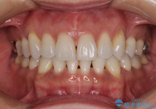 抜歯矯正の後戻りをインビザライン・ライトで解消の症例 治療前