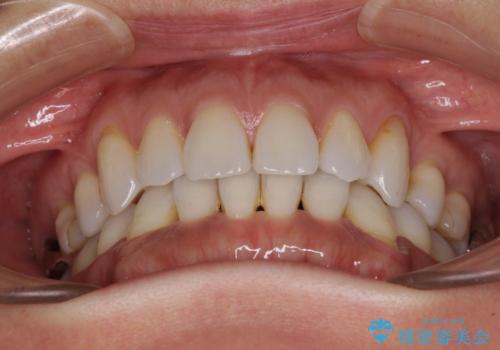 抜歯矯正の後戻りをインビザライン・ライトで解消の治療前