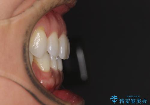 抜歯矯正の後戻りをインビザライン・ライトで解消の治療前