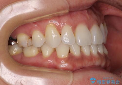 抜歯矯正の後戻りをインビザライン・ライトで解消の治療前