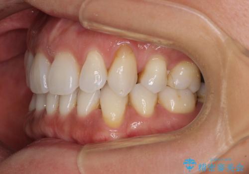 抜歯矯正の後戻りをインビザライン・ライトで解消の治療前