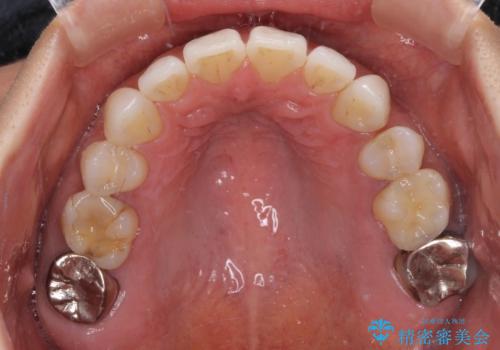 抜歯矯正の後戻りをインビザライン・ライトで解消の治療前