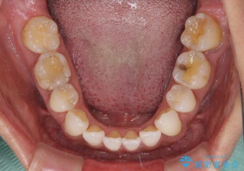 抜歯矯正の後戻りをインビザライン・ライトで解消の治療前