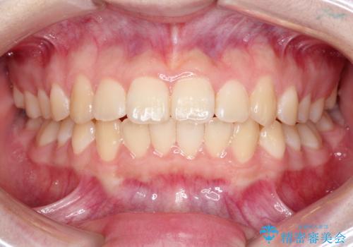 なるべく通院回数を減らして矯正したい インビザラインでのガタガタ矯正の治療後