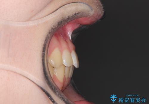 なるべく通院回数を減らして矯正したい インビザラインでのガタガタ矯正の治療後