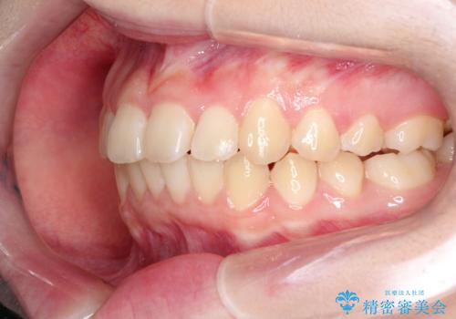 なるべく通院回数を減らして矯正したい インビザラインでのガタガタ矯正の治療後