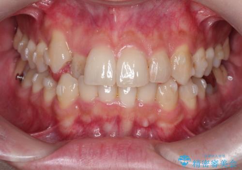 八重歯を抜歯せずに矯正 インビザラインでの治療中