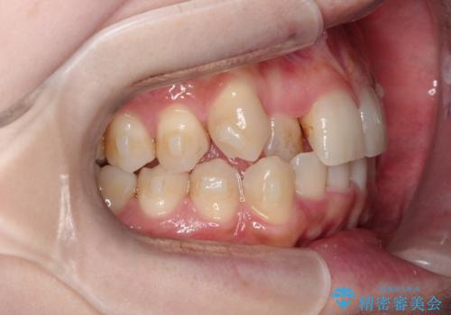 八重歯を抜歯せずに矯正 インビザラインでの治療中