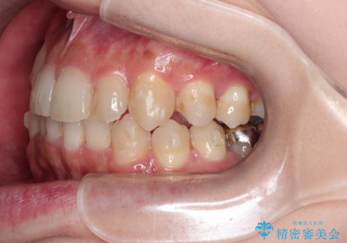 八重歯を抜歯せずに矯正 インビザラインでの治療中
