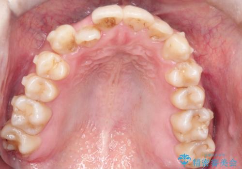 八重歯を抜歯せずに矯正 インビザラインでの治療中