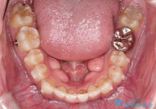 八重歯を抜歯せずに矯正 インビザラインでの治療中