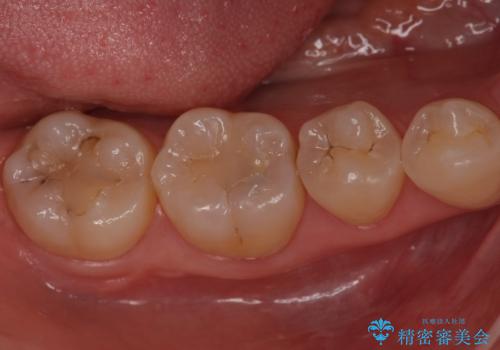 奥歯が黒く、心配。ゴールドインレーで修復の治療前