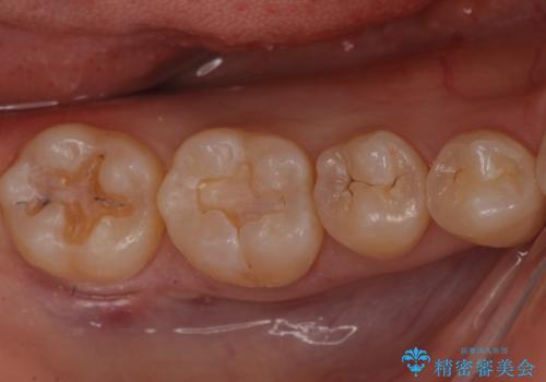奥歯が黒く、心配。ゴールドインレーで修復の治療中