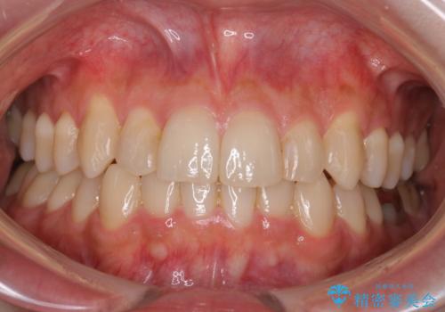 八重歯を抜歯せずに矯正 インビザラインでの症例 治療後