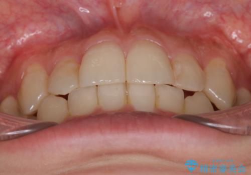 八重歯を抜歯せずに矯正 インビザラインでの治療後