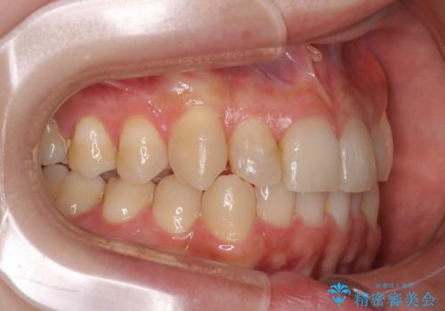 八重歯を抜歯せずに矯正　インビザラインでの治療後