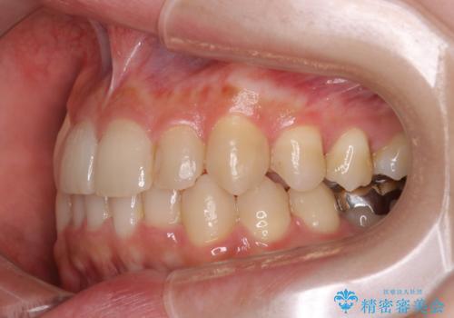八重歯を抜歯せずに矯正 インビザラインでの治療後