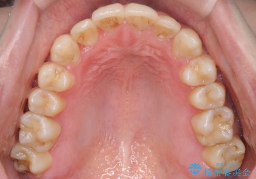 八重歯を抜歯せずに矯正 インビザラインでの治療後