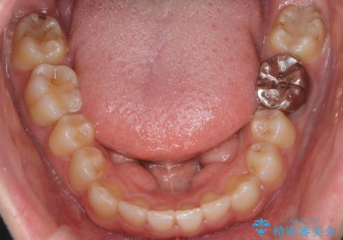 八重歯を抜歯せずに矯正 インビザラインでの治療後