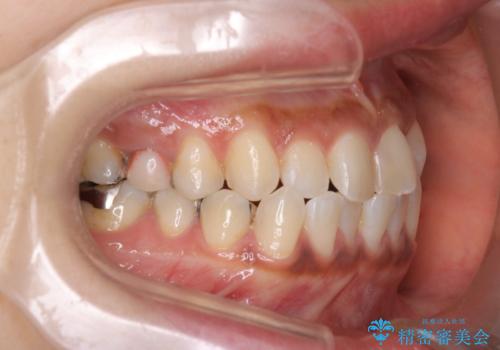 【インビザライン】前歯の凸凹をなおしたいの治療前