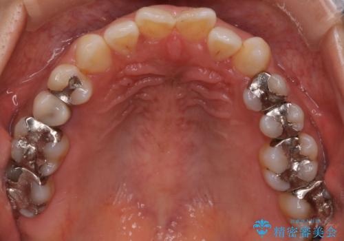【インビザライン】前歯の凸凹をなおしたいの治療前