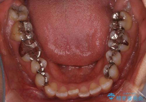 【インビザライン】前歯の凸凹をなおしたいの治療前