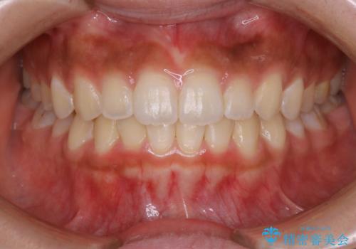 短期間ですきっ歯を改善:インビザラインLiteの治療後