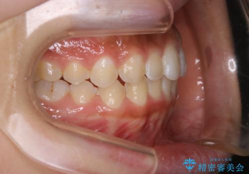短期間ですきっ歯を改善:インビザラインLiteの治療後