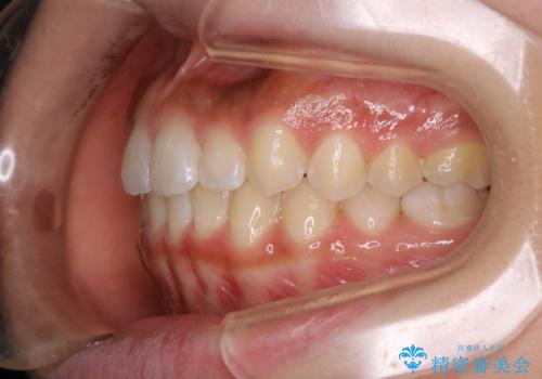 短期間ですきっ歯を改善:インビザラインLiteの治療後