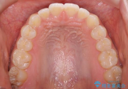 短期間ですきっ歯を改善:インビザラインLiteの治療後
