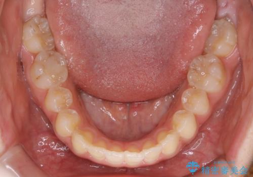 短期間ですきっ歯を改善:インビザラインLiteの治療後