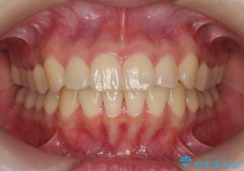 オフィスホワイトニングで、口元明るく爽やかに!!の治療前