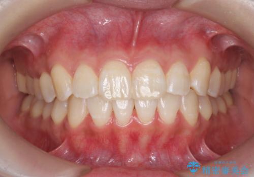 オフィスホワイトニングで、口元明るく爽やかに!!の治療後