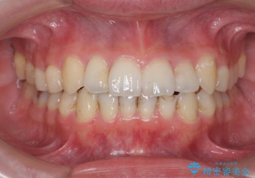 歯の着色をPMTC(医院で行うプロフェッショナルクリーニング)で除去!の治療前