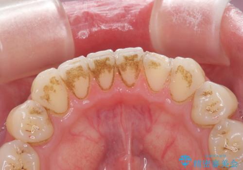歯の着色をPMTC(医院で行うプロフェッショナルクリーニング)で除去!の治療前