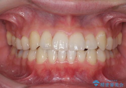 歯の着色をPMTC(医院で行うプロフェッショナルクリーニング)で除去!の治療後