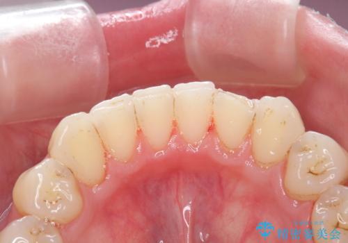 歯の着色をPMTC(医院で行うプロフェッショナルクリーニング)で除去!の治療後